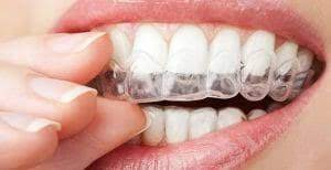 Clear overlay Retainer